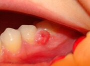 киста зуба симптомы