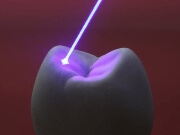 лечение зубов лазером