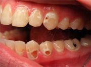 разрушение зубов причины