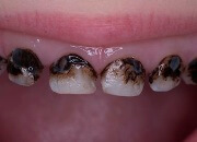 альтернатива серебрению молочных зубов