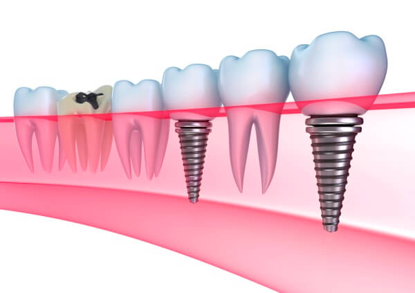 классическая процедура по вживлению зубных имплантатов