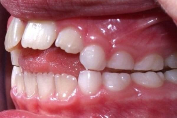 почему возникает открытый прикус зубов