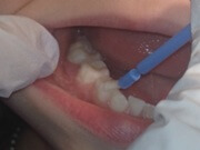 фторирование зубов у детей