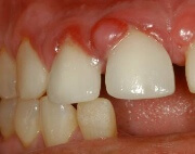 лечение гранулемы зуба цена