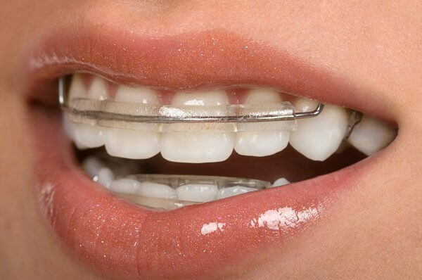 зубные пластины для выравнивания зубов