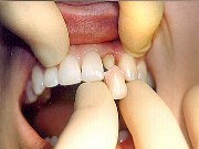 металлокерамические коронки на передние зубы