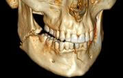 перелом нижней челюсти лечение