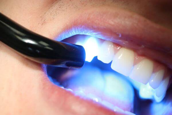 вредно ли отбеливание зубов лазером