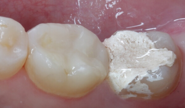нюансы использования мышьяка в стоматологии 