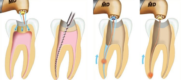 Порядок проведения чистки каналов зуба