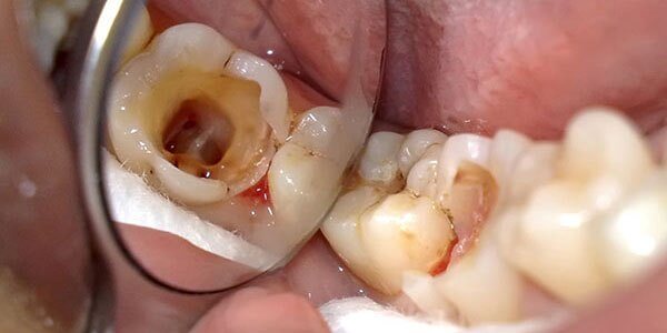 Как проводится операция чистки каналов зуба