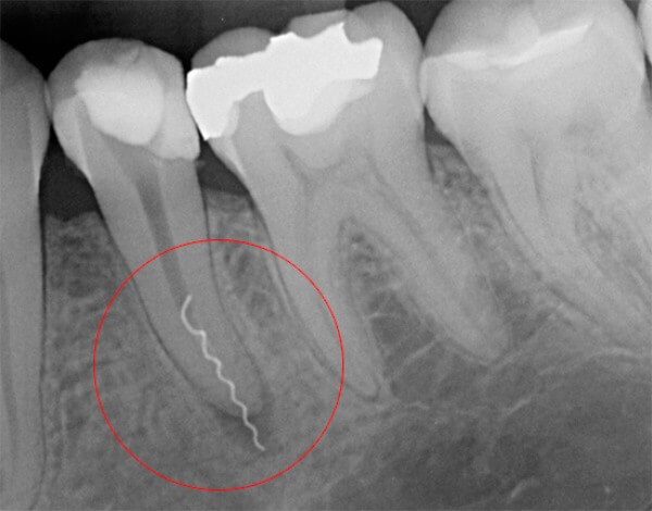 Причины боли после чистки каналов зуба