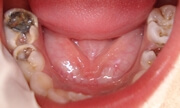 Основные причины разрушения зубов у детей