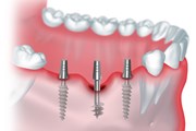 Чем отличается базальная имплантация зубов