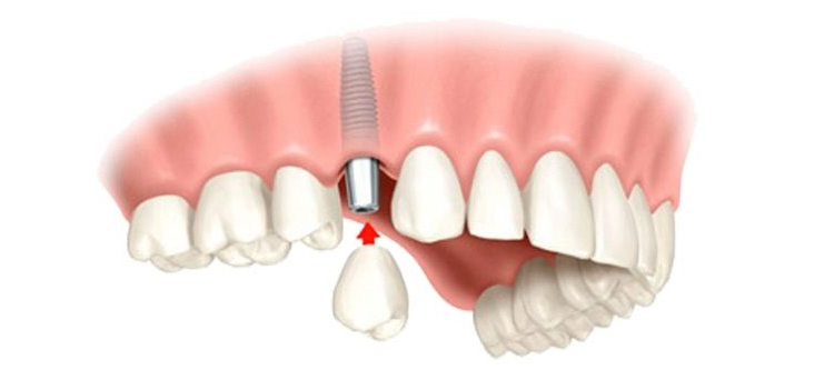 В какой последовательности проводится одномоментная имплантация зубов