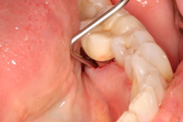 Как проводится дренаж при абсцессе зуба