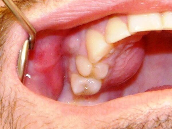 Почему опухает десна при абсцессе зуба