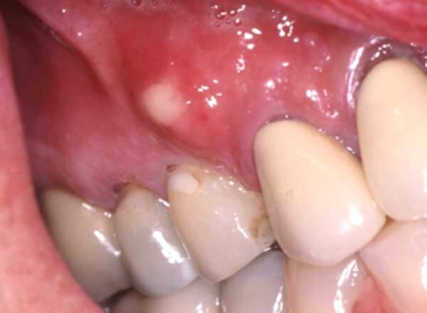 Возникновение гнойников на десне при абсцессе зуба