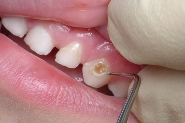 Как лечить средний кариес молочных зубов