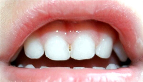 Приемы лечения среднего контактного кариеса молочных зубов