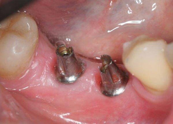 Почему происходит отторжение зубного имплантата