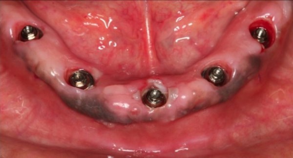 Причины возникновения гематом после имплантации зубов
