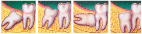 Возможные положения зубов при перикоронарите