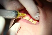 Список противопоказаний для плазмолифтинга в стоматологии 
