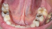 Как происходит лечение пульпита молочных зубов у детей 