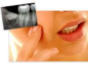 Методы лечения воспаления надкостницы зуба 