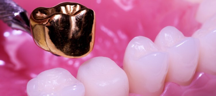 Установка золотых коронок на зубы