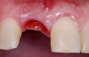 Особенности лечения альвеолита после удаления зуба