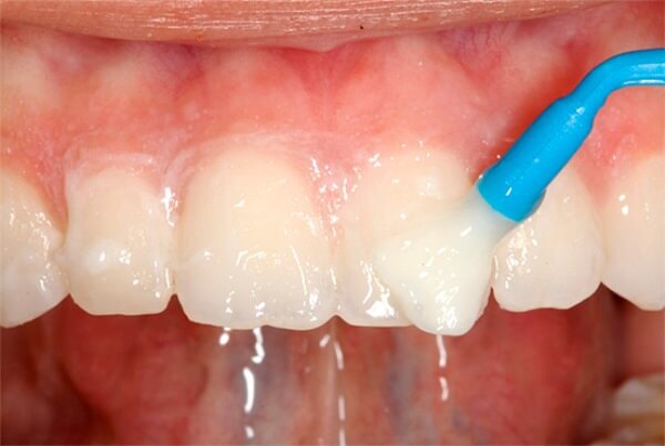Особенности реминерализации зубов при флюорозе