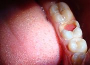 Как лечить запущенный пульпит зуба