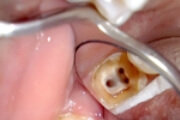 Как лечить пульпит трехканального зуба