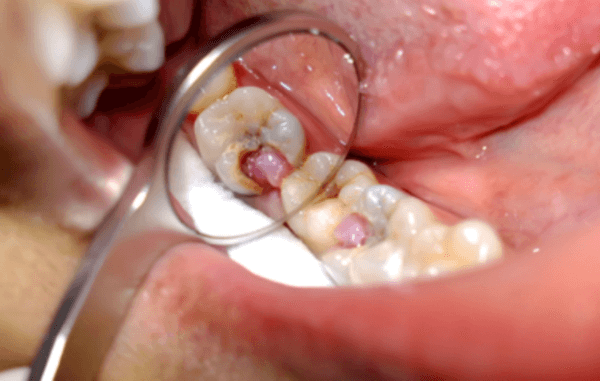Какие заболевания вызывают зубную боль по ночам