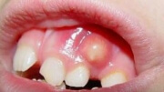 Методы лечения абсцесса зуба 