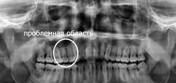 Рентгенографический снимок зубов с глубокой кариозной полостью