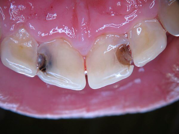 Внешний вид кариеса между передними зубами