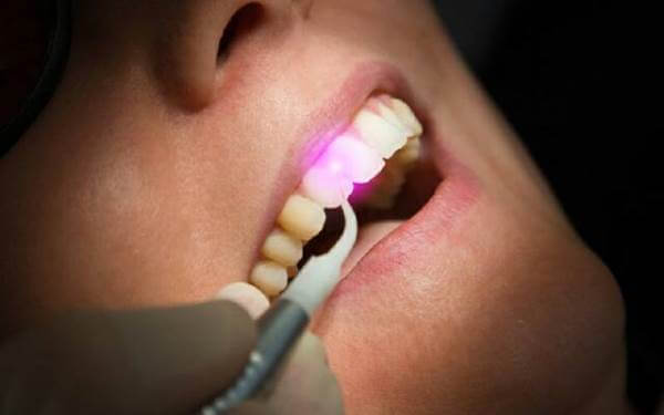 Как лечить кариес между передними зубами