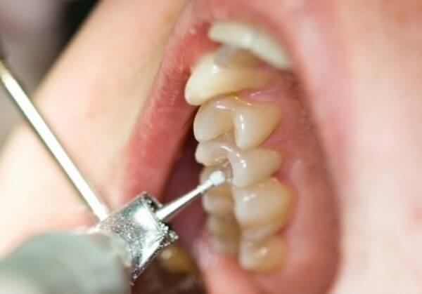 Методы препарирования зуба при лечениии глубокого кариеса