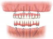 Процедура протезирования на имплантах при полном отсутствии зубов