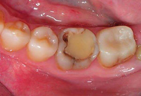 Разрушение зуба под пломбой