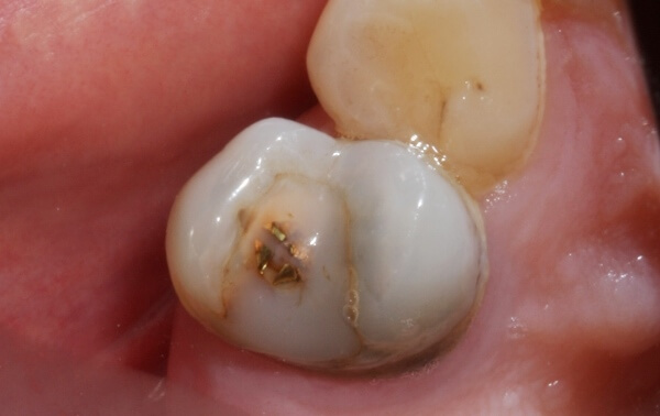 Омертвение тканей зуба под пломбой