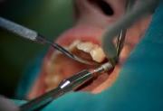 Последовательность хирургического этапа имплантации зубов