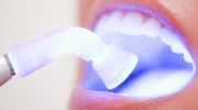 Отзывы о преимуществах лазерного отбеливания зубов