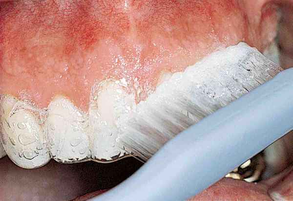 Преимущества зубной пасты Opalescence
