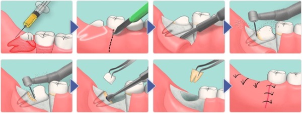Как происходит процесс удаления ретинированного зуба мудрости