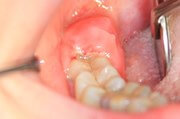 Характерные симптомы воспаления зуба мудрости 