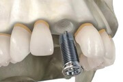 Сколько стоит вставить протез одного зуба
